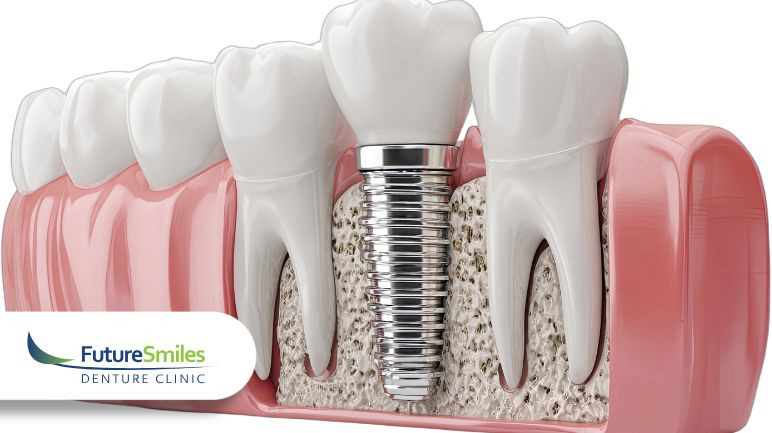 The Denture Implant Process Explained: From Consultation to Final Fit – Calgary Denture Implants
